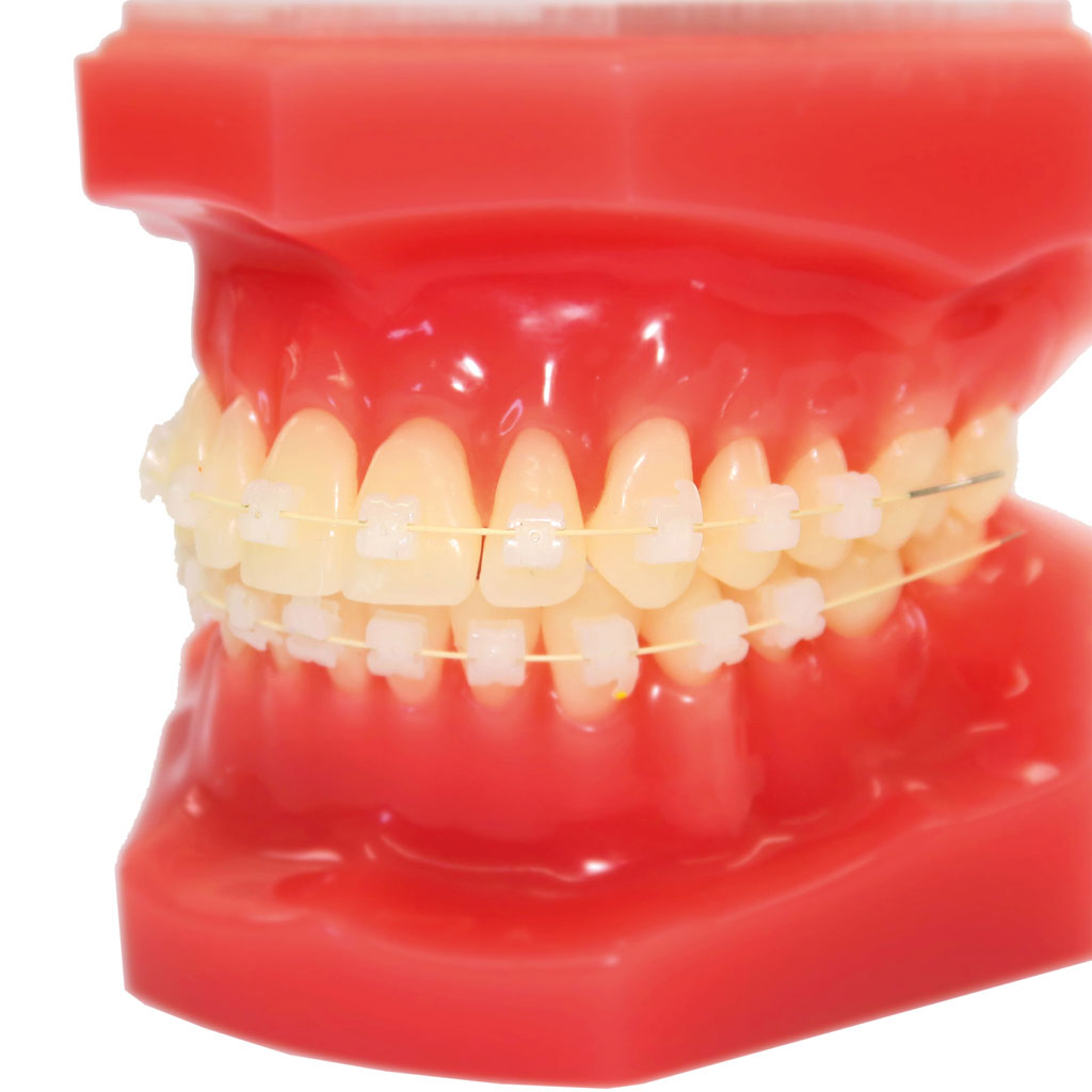 [866-003/H] BREEZE SL Tooth colored MBT .022 (Fall) (3-3 OK & UK mit Haken auf 3)