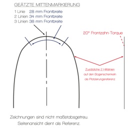 FLEXADENT NiTi SE Pre-Torqued